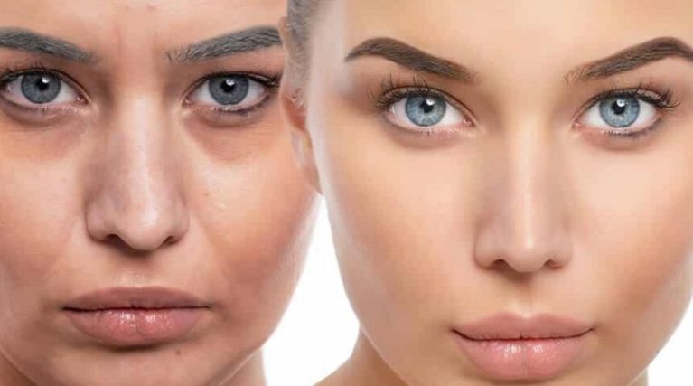 PRP (Platelet Rich Plasma) ile Cilt Gençleştirme kıbrıs
