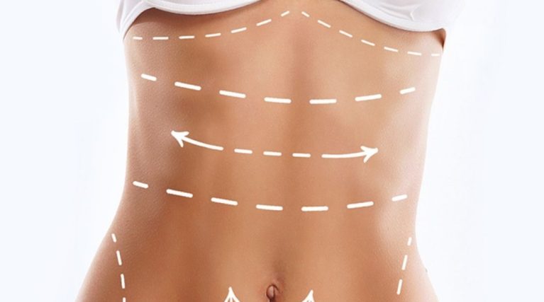 Total Body Lift – Tüm Vücut Şekillendirme