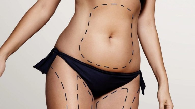 Vaser Liposuction