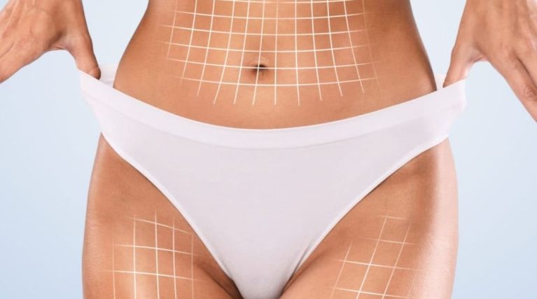 Vücut Estetiği (Body Contouring) kıbrıs