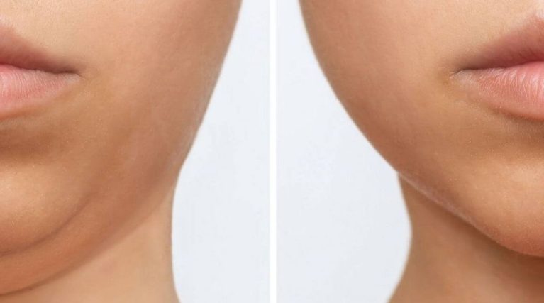 endolift