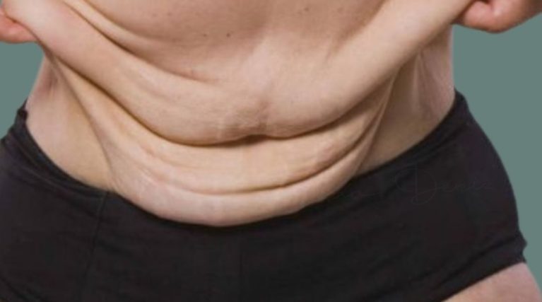 lowerbodylift-kktc